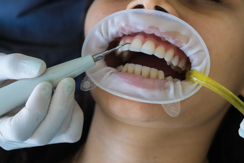 arafed woman getting her teeth brushed by a dentist