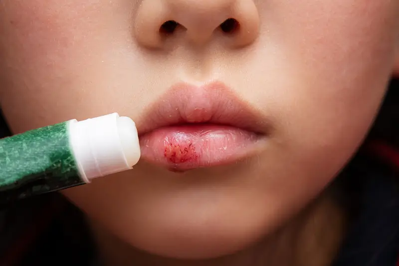 What They Are and How Laser Therapy Can Help