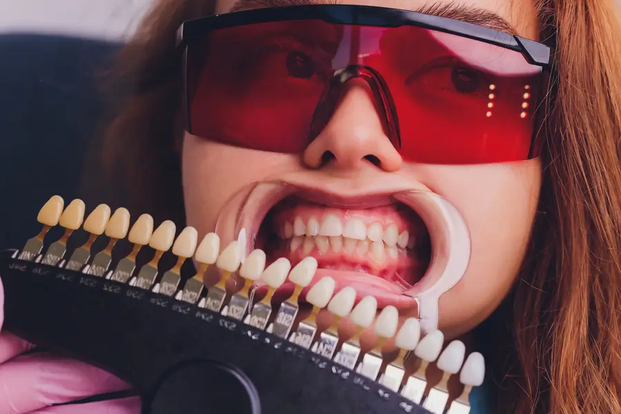 How Do Veneers Work? Key Facts from Advanced Dental Arts NYC