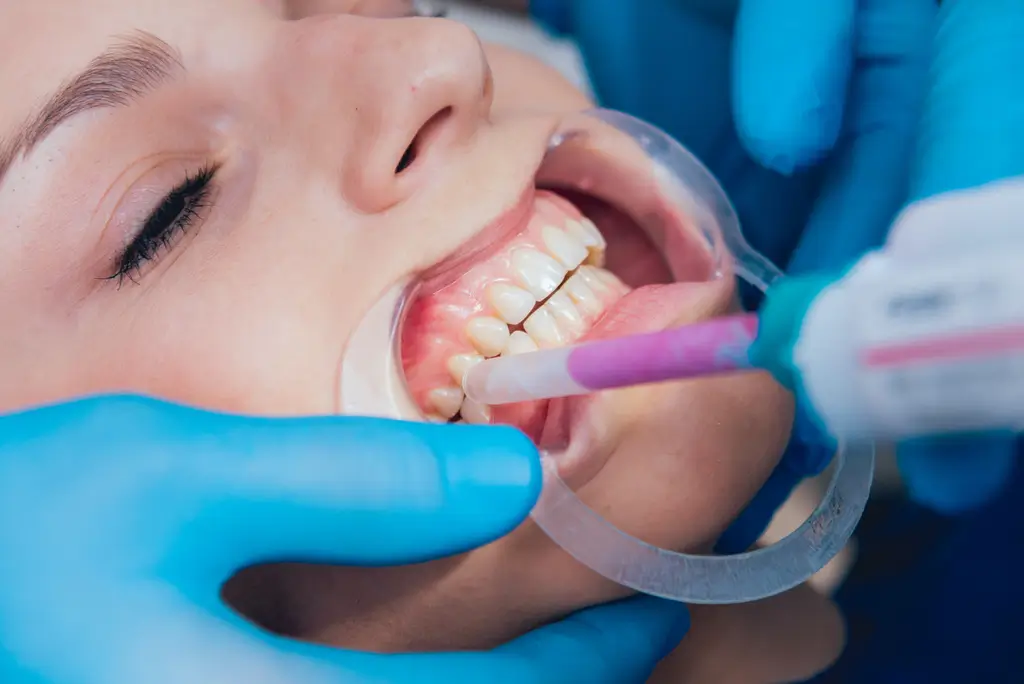 Close-up of a dental procedure with a patient receiving gum treatment or composite application using a dental syringe.