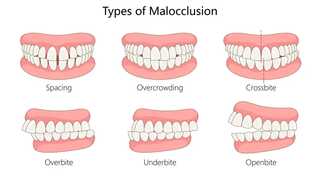 Illustrated chart showing six types of malocclusion: spacing, overcrowding, crossbite, overbite, underbite, and open bite.