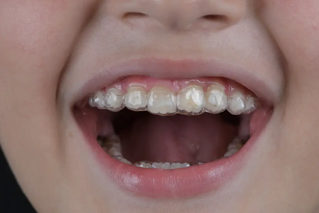 Young patient smiling with clear aligners on their teeth, showing an early stage of orthodontic treatment.